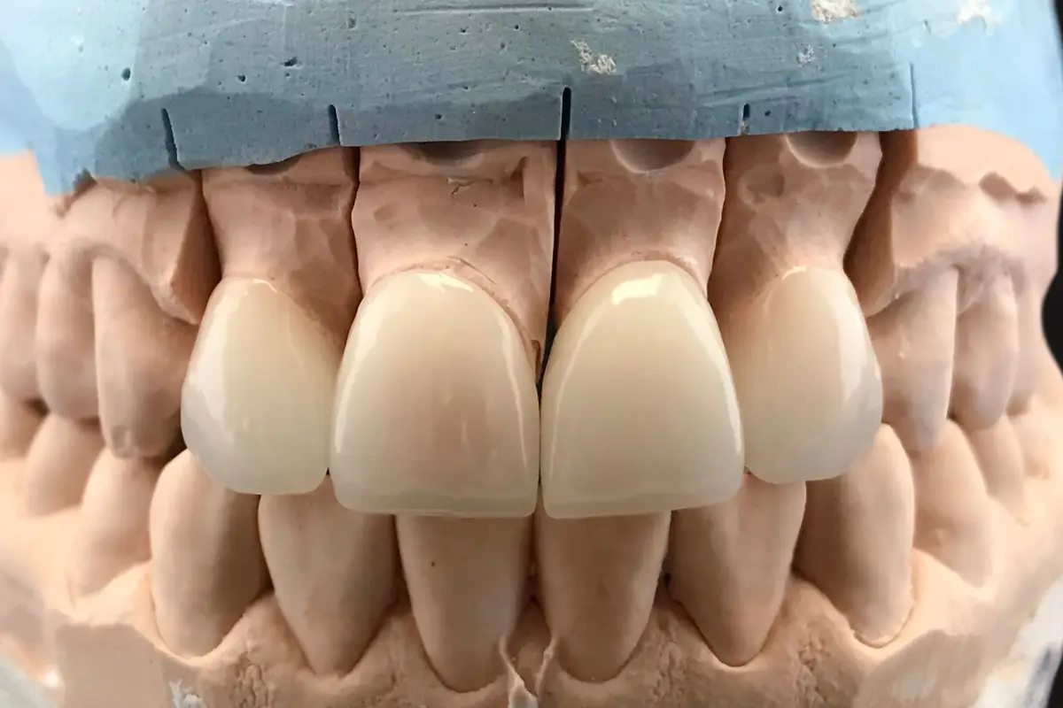 Porcelain Veneers