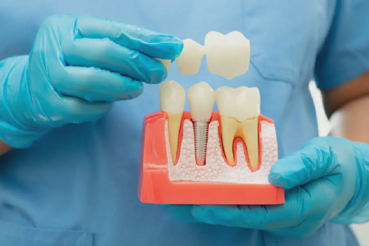 dental crown sample